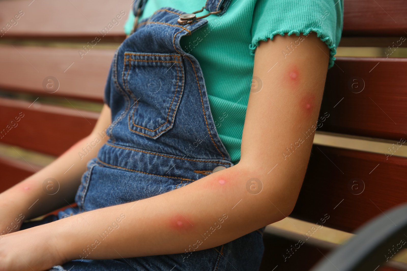 Photo of Girl with insect bites on arm outdoors, closeup