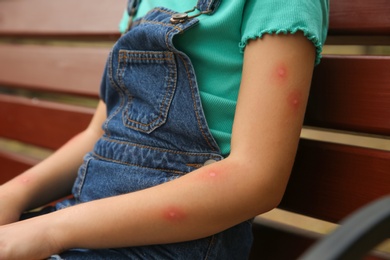 Photo of Girl with insect bites on arm outdoors, closeup