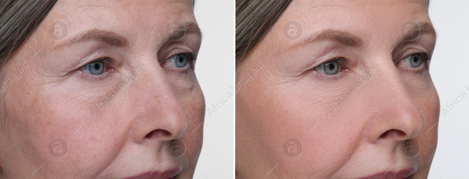 Image of Aging skin changes. Collage with photos of mature woman before and after cosmetic procedure on white background, closeup