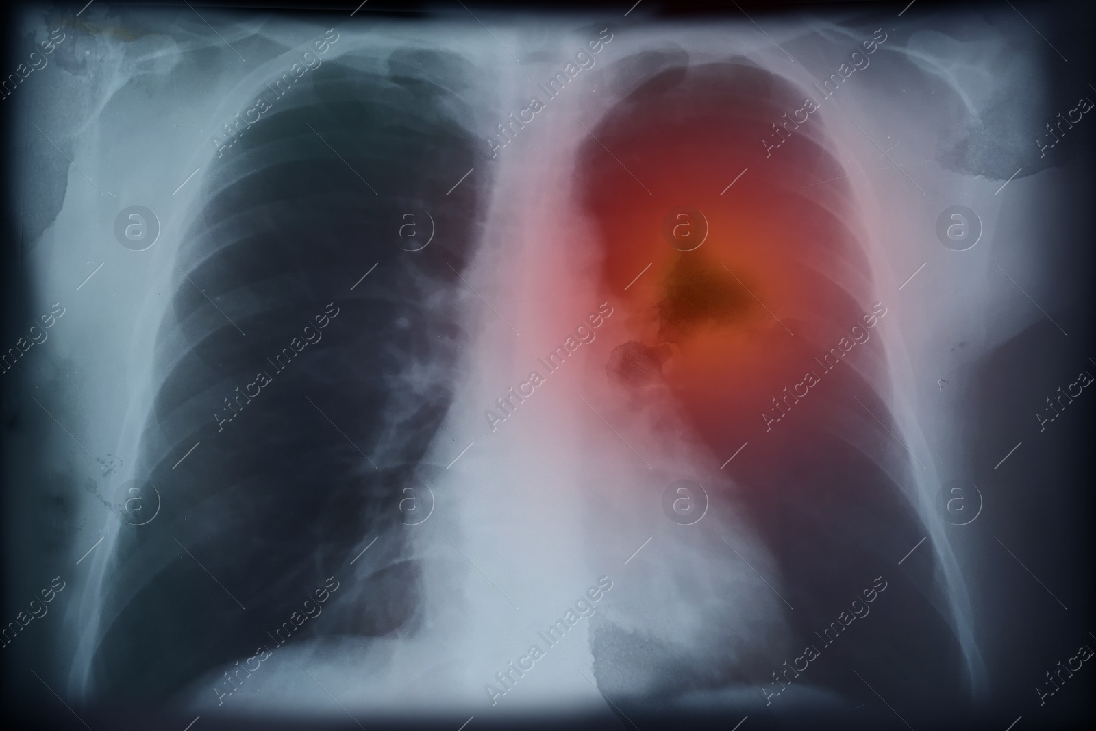 Illustration of X-ray image of patient with lung cancer. Illustration