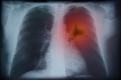 X-ray image of patient with lung cancer. Illustration