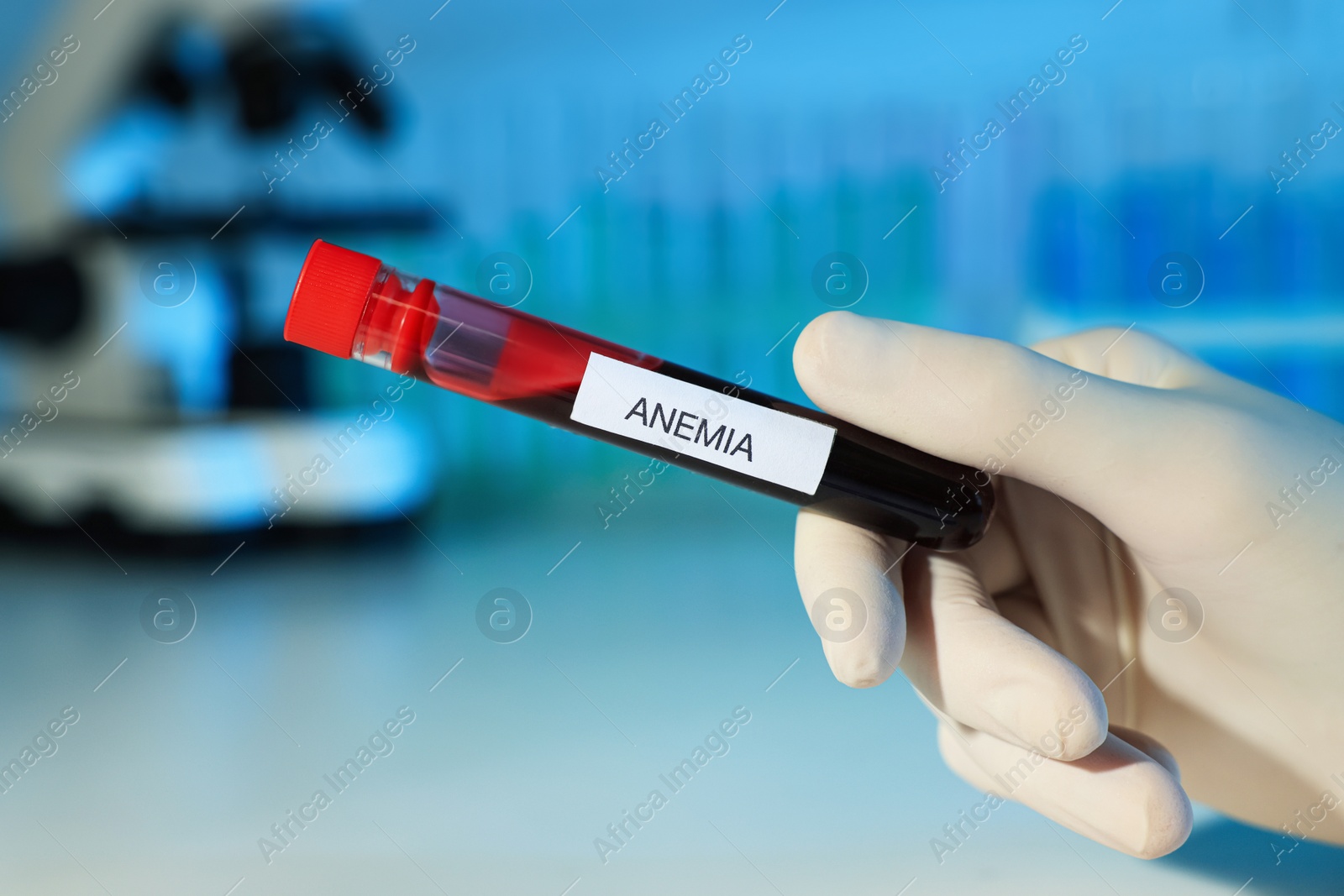 Photo of Scientist holding test tube with blood sample and label Anemia on blurred background, closeup
