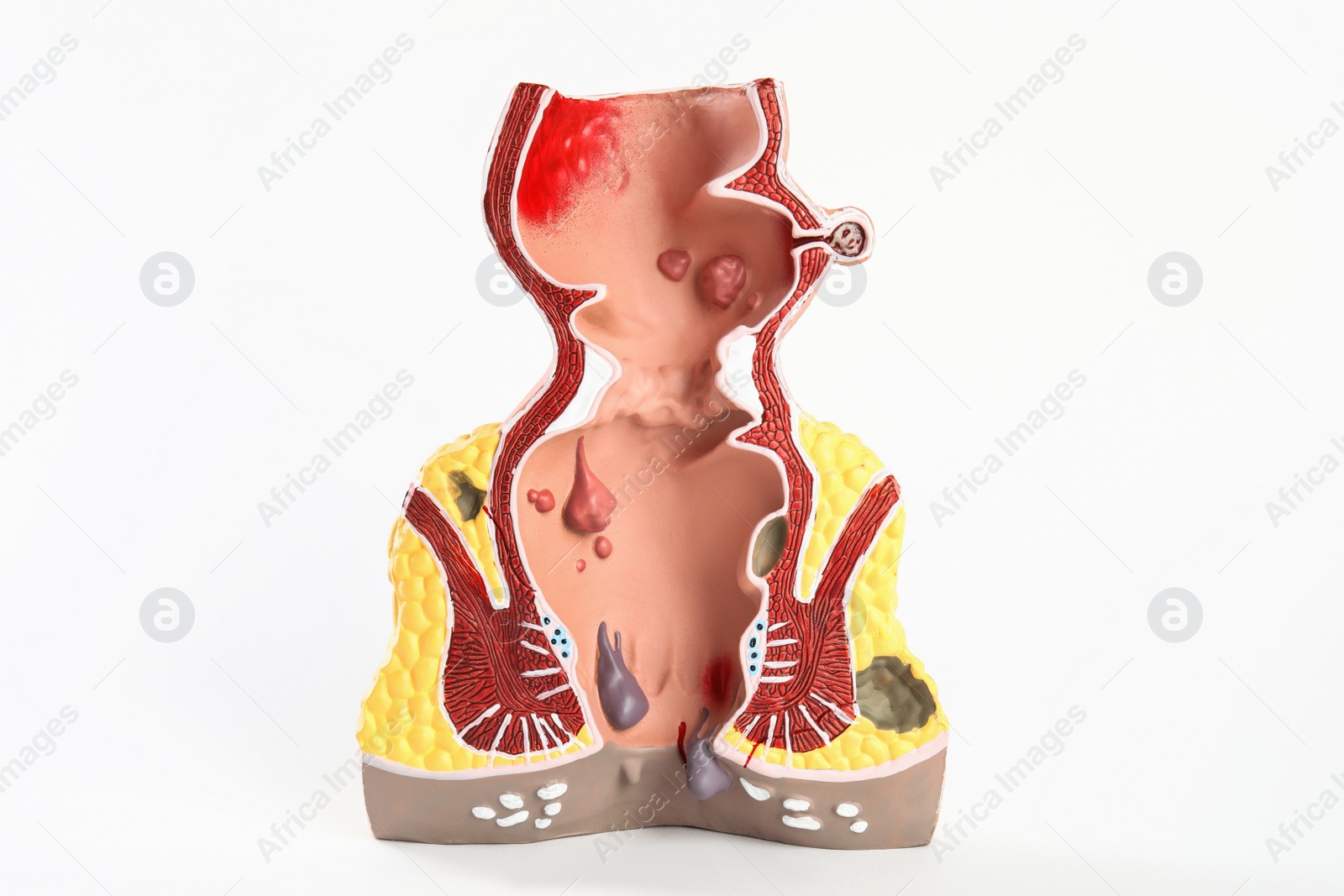 Photo of Anatomical model of rectum with hemorrhoids isolated on white