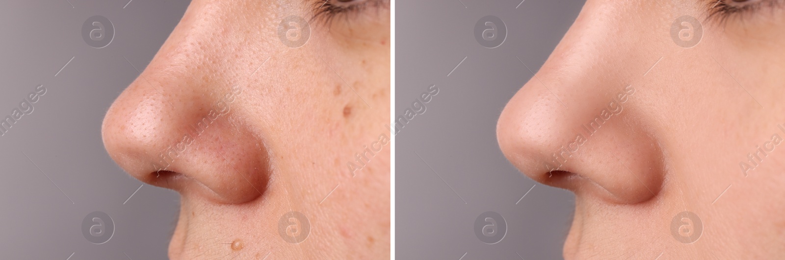 Image of Before and after acne treatment. Photos of woman on grey background, closeup. Collage showing affected and healthy skin