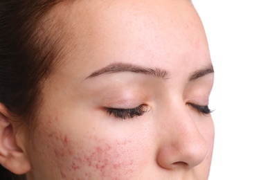 Photo of Teenage girl with acne problem on white background, closeup