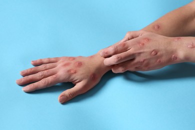Photo of Woman with rash suffering from monkeypox virus on light blue background, closeup