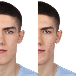 Image of Acne problem. Young man before and after treatment on white background, collage of photos