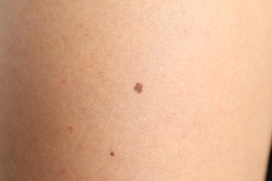 Closeup view of woman's body with birthmarks