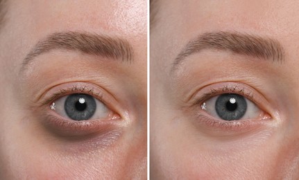 Image of Collage with photos of woman with dark circle under eye before and after treatment, closeup