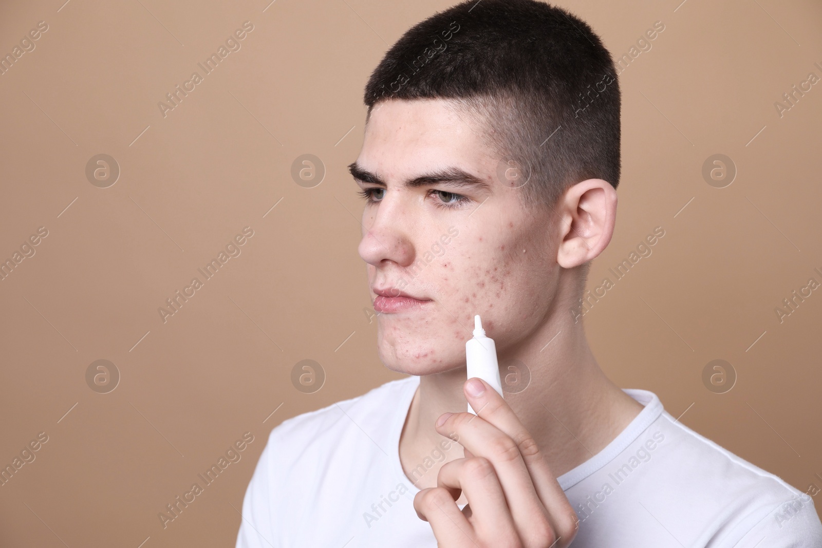 Photo of Young man with acne problem applying cosmetic product onto his skin on beige background. Space for text