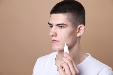 Young man with acne problem applying cosmetic product onto his skin on beige background. Space for text