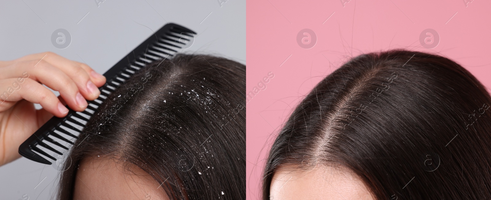 Image of Woman showing hair before and after dandruff treatment on color backgrounds, collage