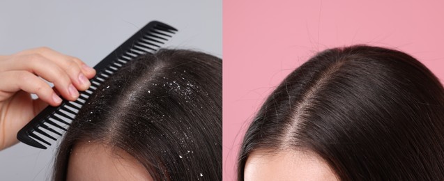 Woman showing hair before and after dandruff treatment on color backgrounds, collage