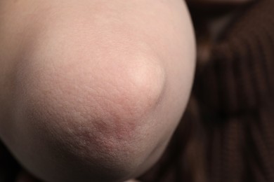 Photo of Woman with dry skin on elbow against blurred background, closeup