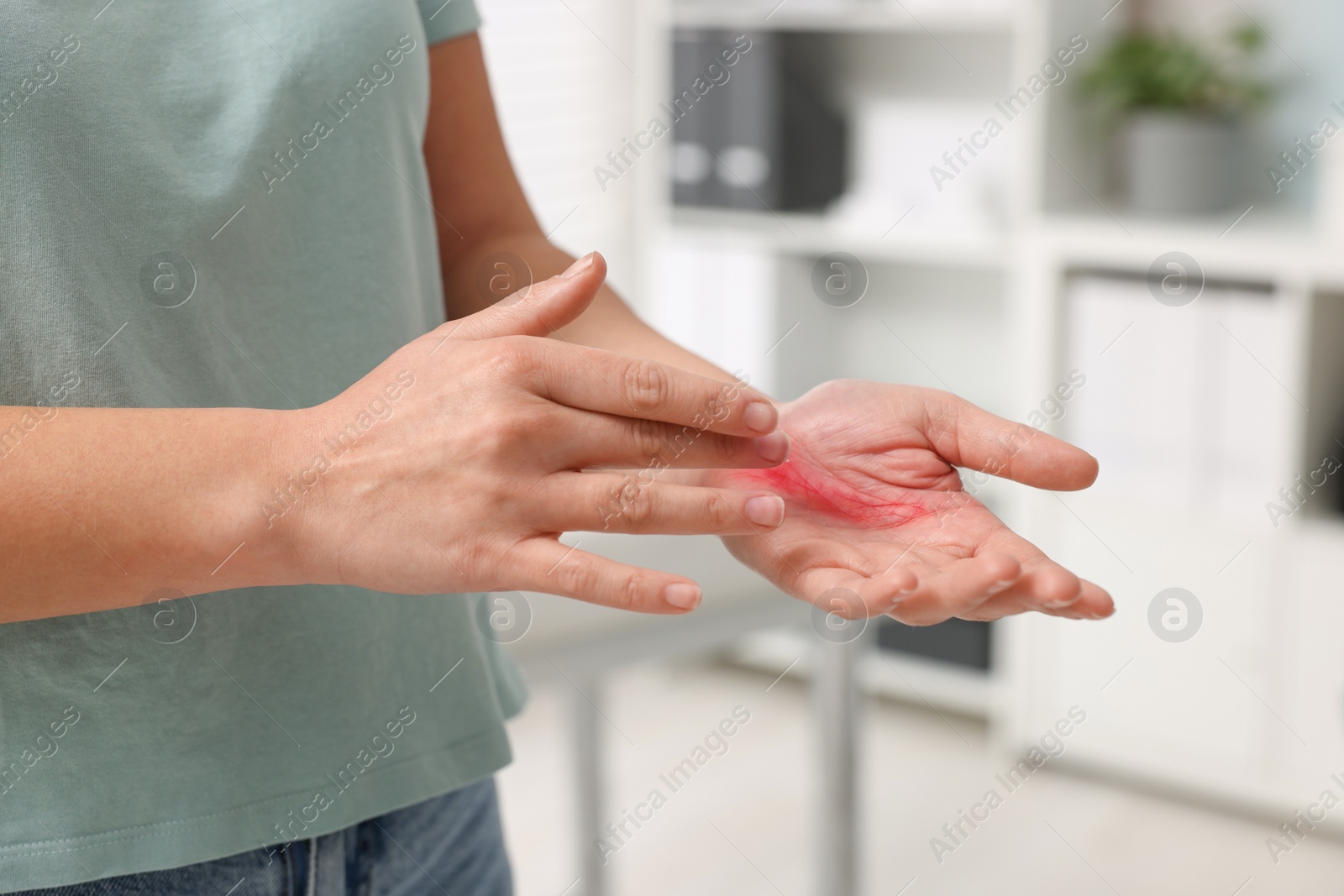 Photo of Woman with burned hand indoors, closeup view