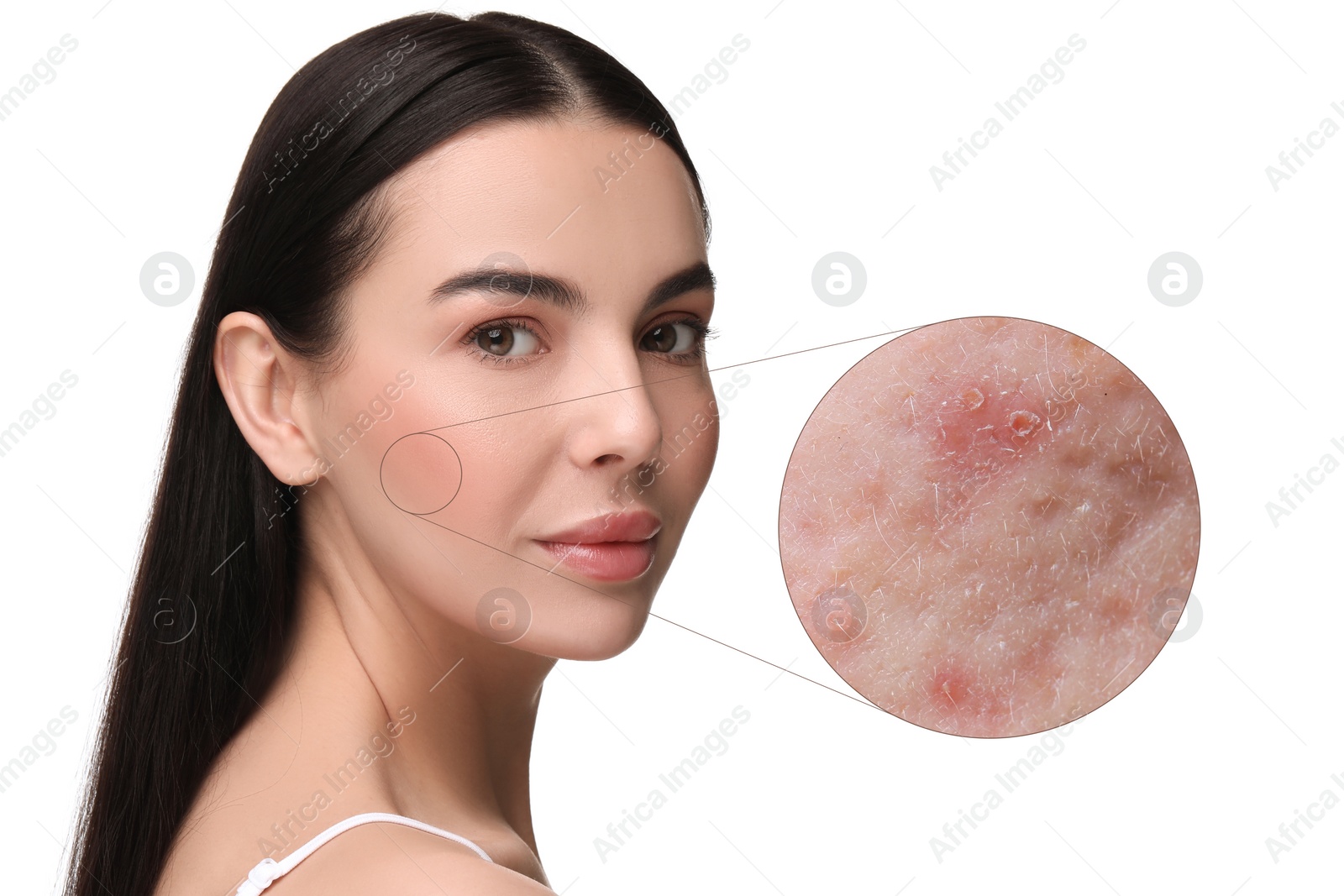 Image of Dermatology. Woman with skin problem on white background. Zoomed area showing acne