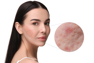 Dermatology. Woman with skin problem on white background. Zoomed area showing acne
