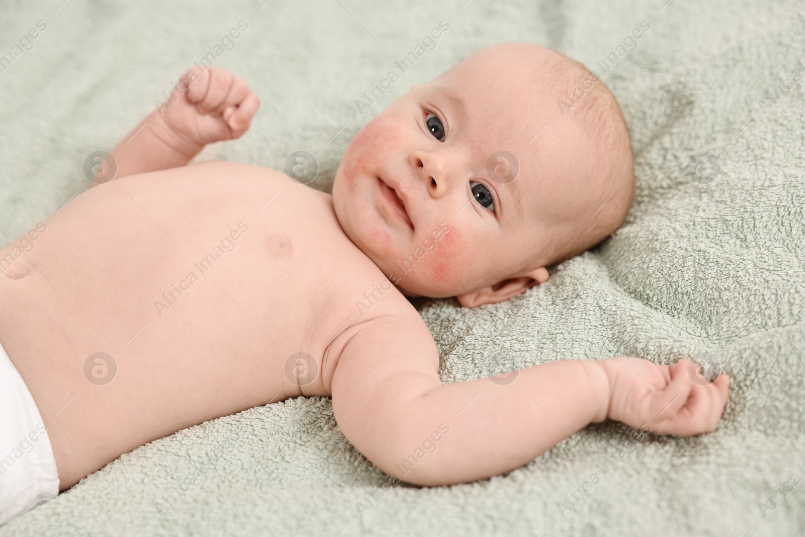 Photo of Cute little baby with allergic redness on cheeks lying on light green blanket