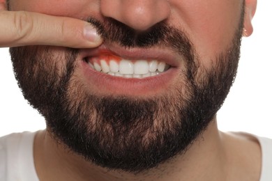 Image of Young man showing inflamed gums, closeup view