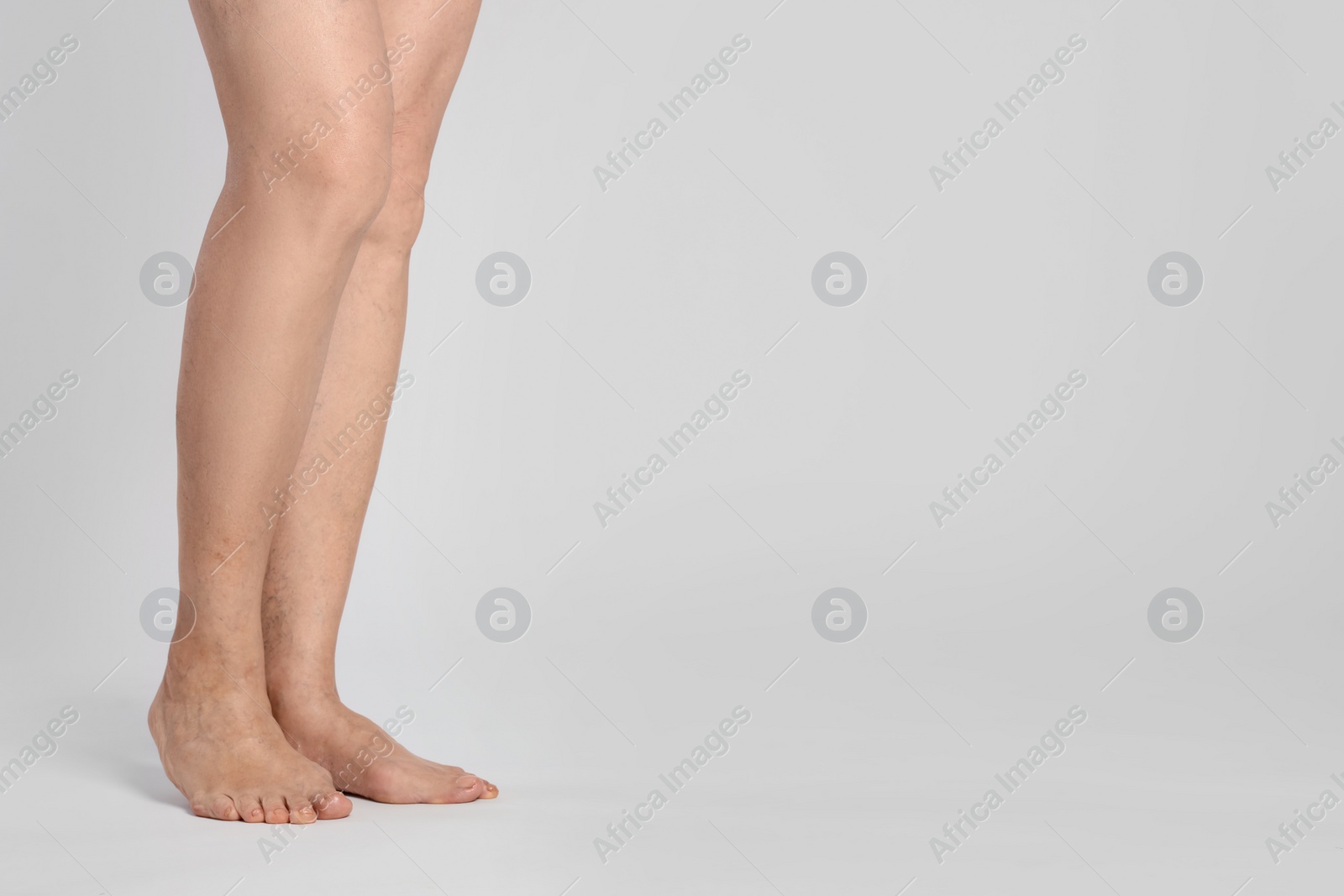 Photo of Closeup view of woman with varicose veins on light background. Space for text