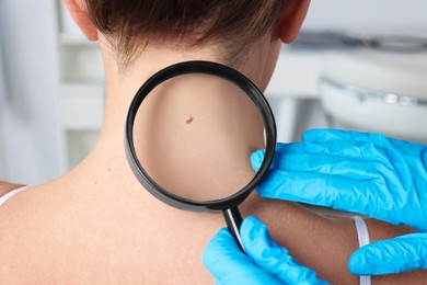 Dermatologist examining patient's birthmark with magnifying glass in clinic, closeup