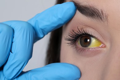 Photo of Doctor checking woman with yellow eyes on light background, closeup. Symptom of hepatitis