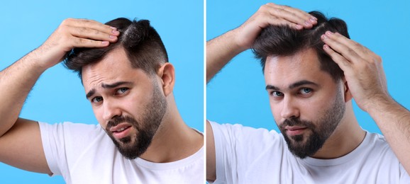 Man showing hair before and after dandruff treatment on light blue background, collage