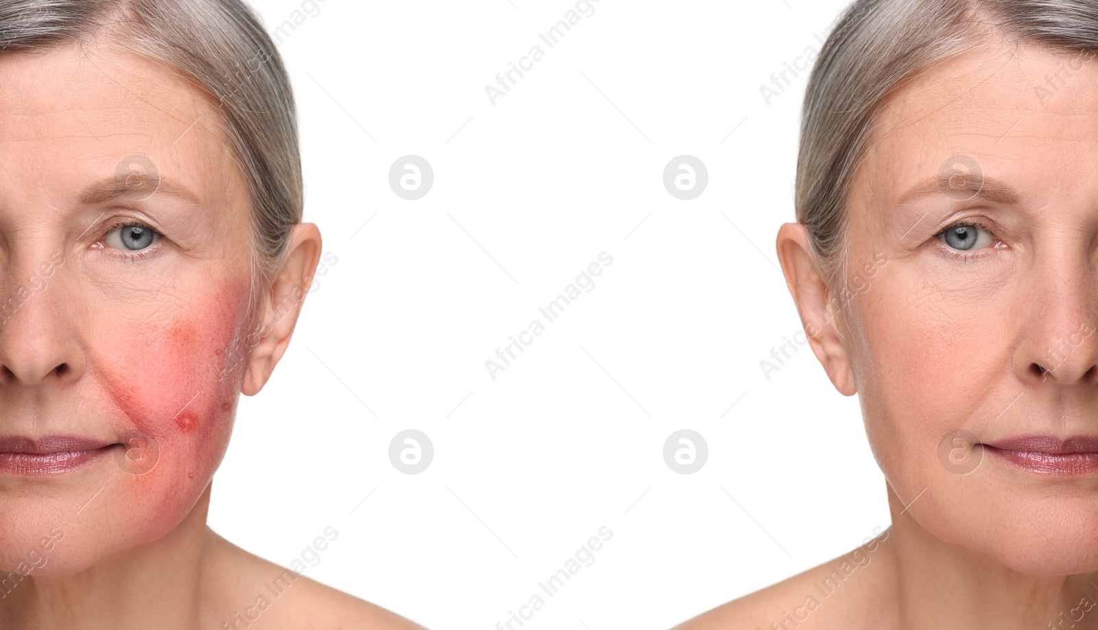 Image of Before and after rosacea treatment. Photos of woman on white background, closeup. Collage showing affected and healthy skin