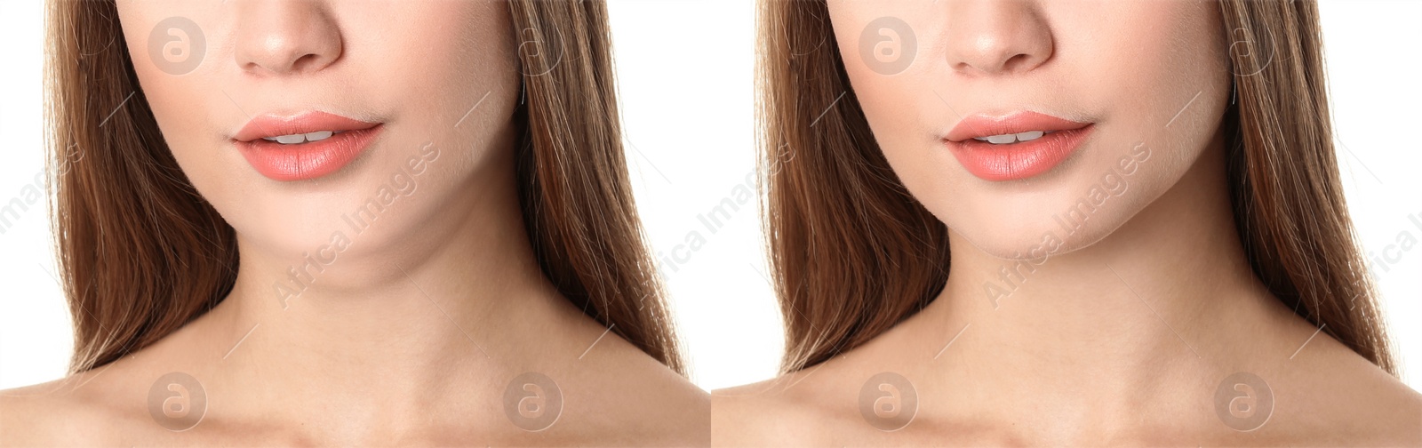 Image of Double chin problem. Collage with photos of young woman before and after plastic surgery procedure on white background, closeup