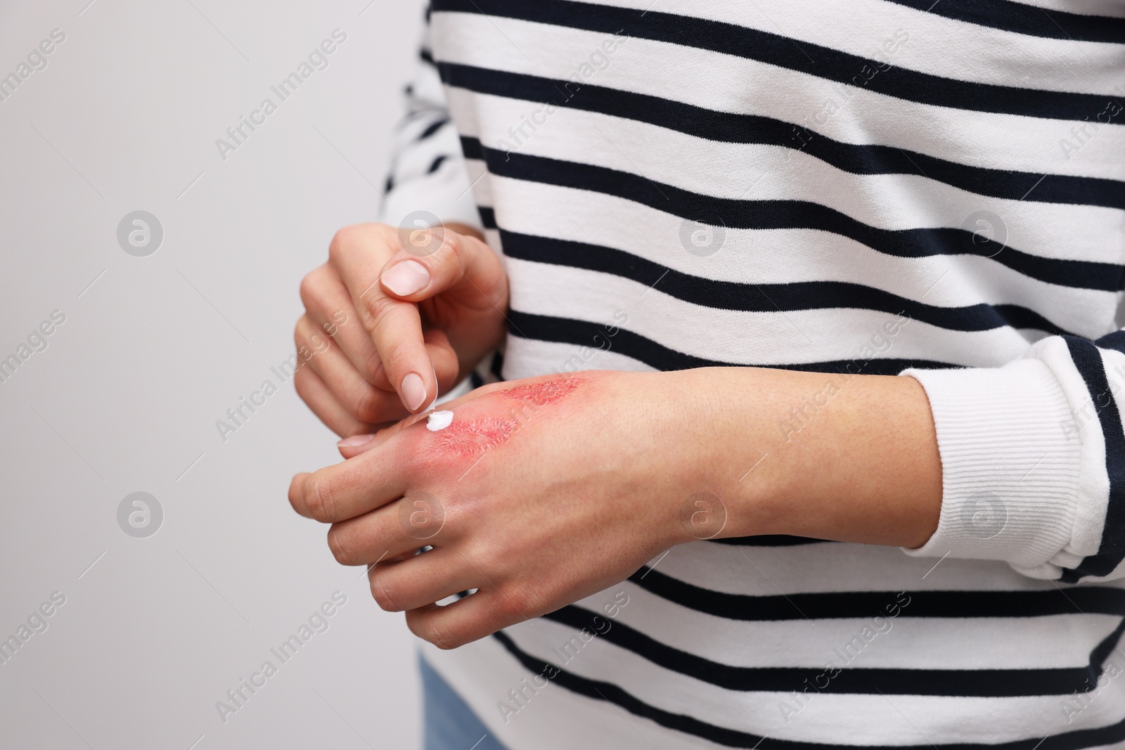 Photo of Woman applying healing cream onto burned hand on light grey background, closeup