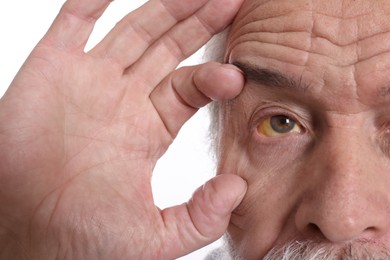 Senior man with yellow eyes on white background, closeup. Symptom of hepatitis