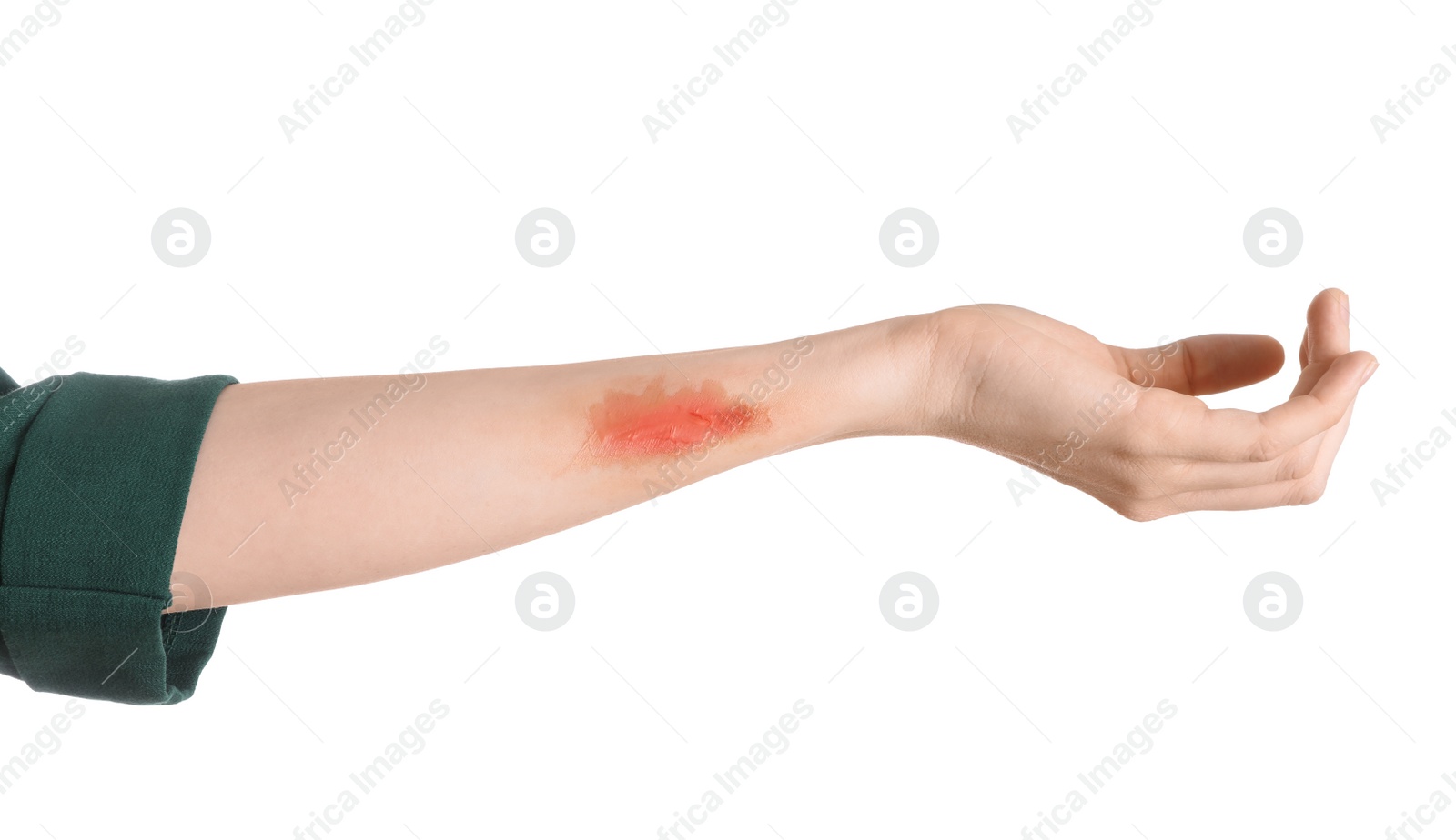 Photo of Woman with burned hand on white background, closeup