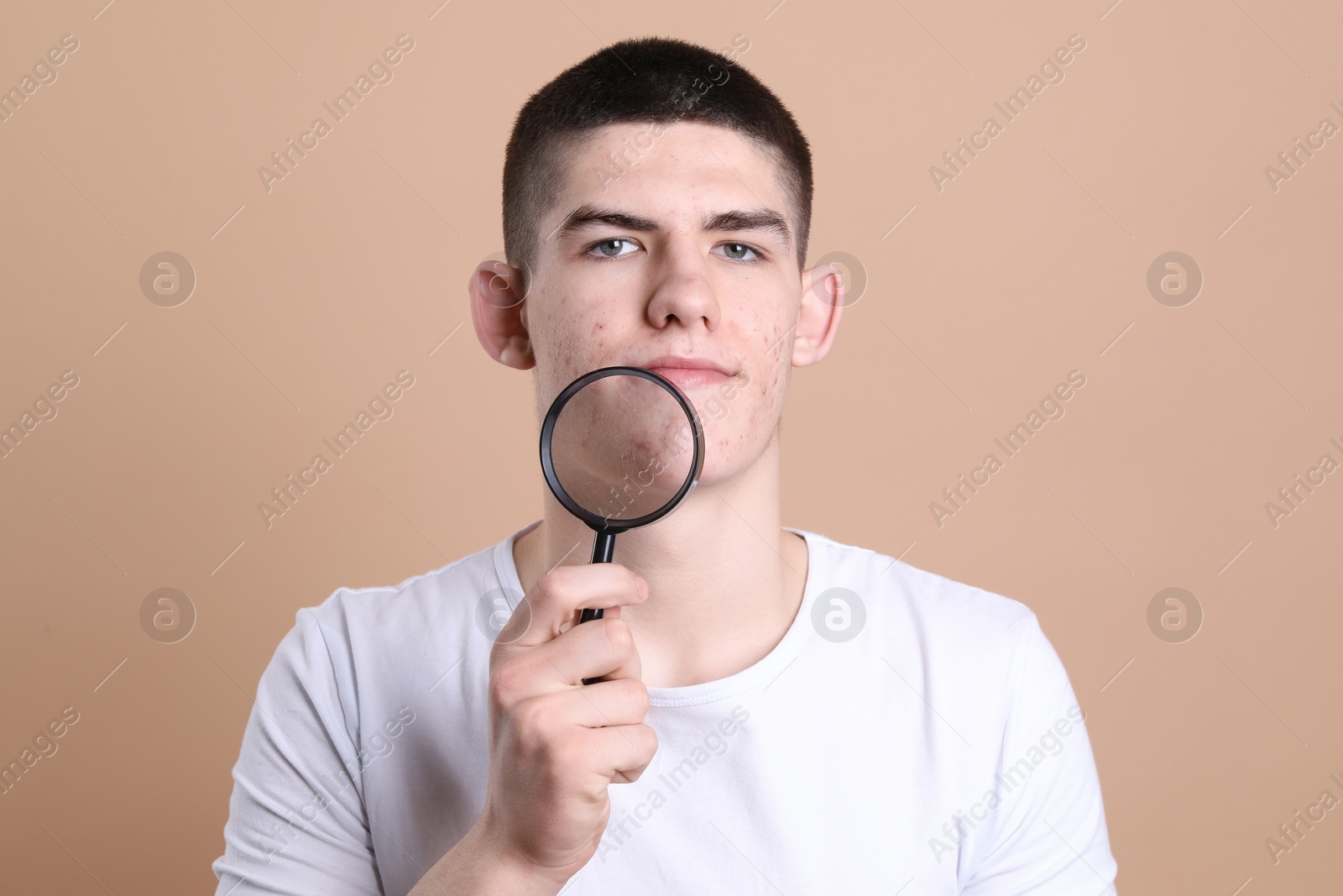 Photo of Young man with acne problem holding magnifying glass on beige background
