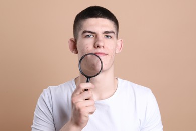 Young man with acne problem holding magnifying glass on beige background