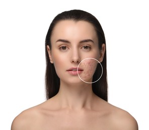 Image of Woman before and after cosmetology procedure on white background. Zoomed area showing problem skin