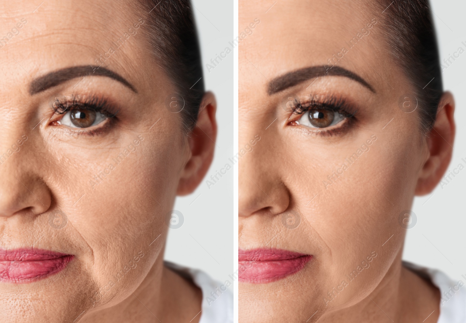 Image of Collage with photos of mature woman before and after biorevitalization procedure, closeup