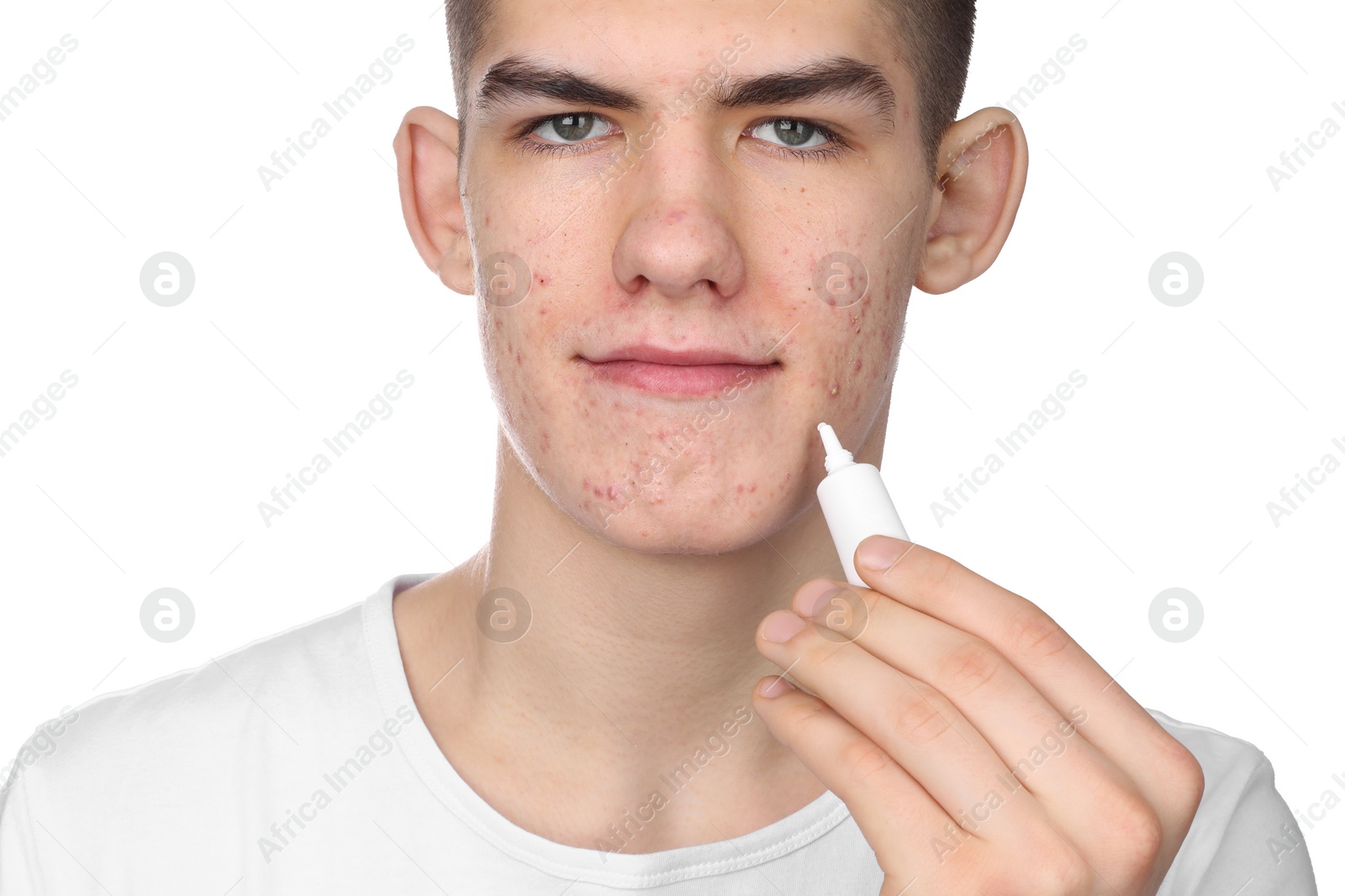 Photo of Young man with acne problem applying cosmetic product onto his skin on white background