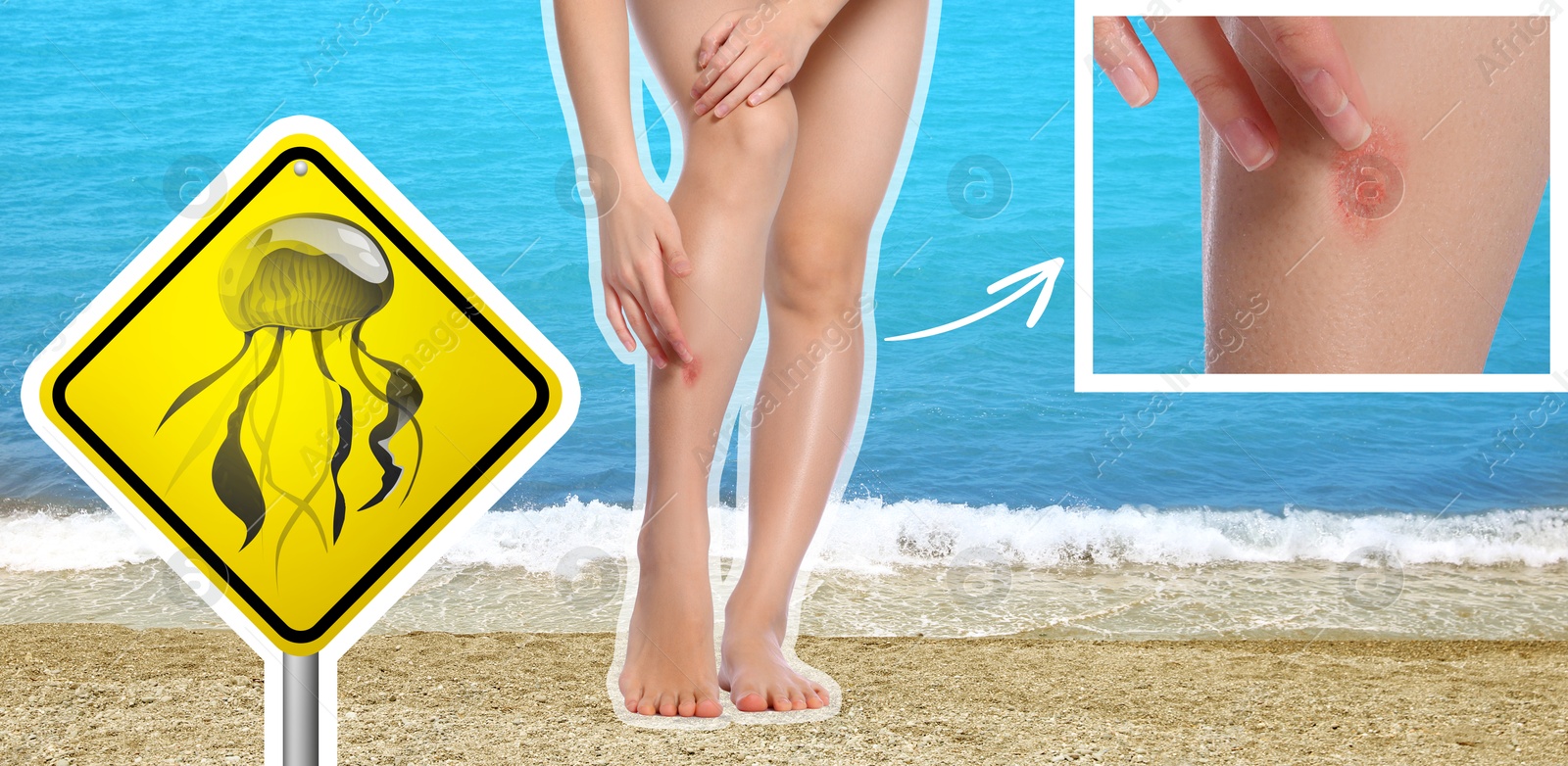 Image of Jellyfish warning sign and injured woman on beach. Banner design