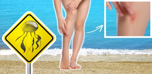 Image of Jellyfish warning sign and injured woman on beach. Banner design