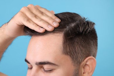 Photo of Man with dandruff in his dark hair on light blue background, closeup