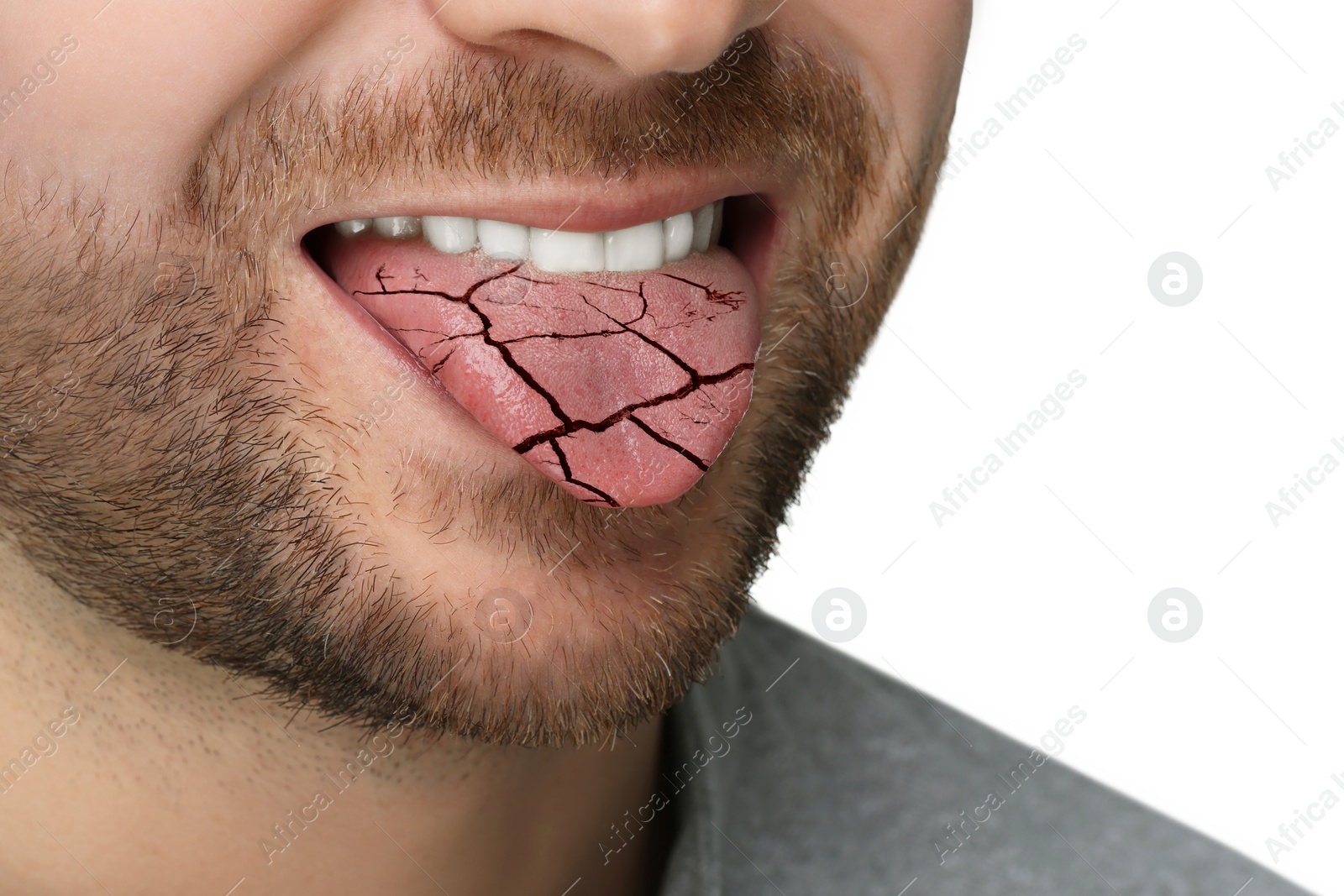 Image of Dry mouth symptom. Man showing dehydrated tongue on white background, closeup