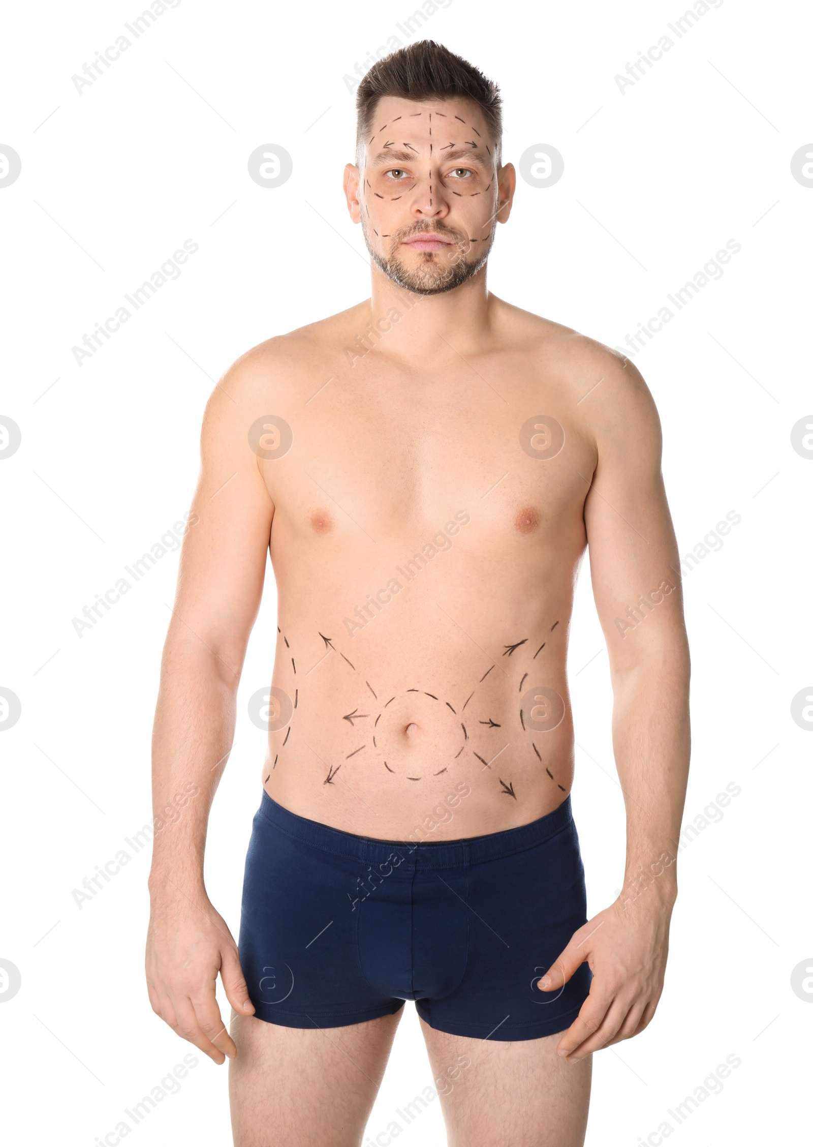 Photo of Man with marks on belly for cosmetic surgery operation against white background