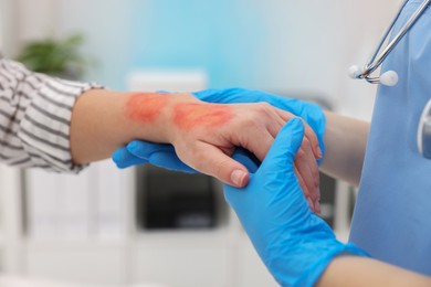 Doctor examining patient's burned hand in hospital, closeup
