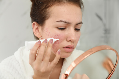 Photo of Teen girl with acne problem applying cream using mirror in bathroom