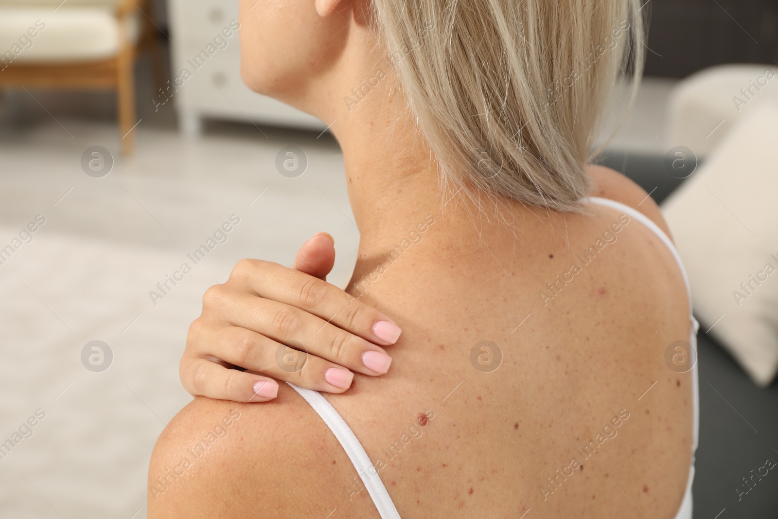 Photo of Closeup view of woman`s body with birthmarks indoors