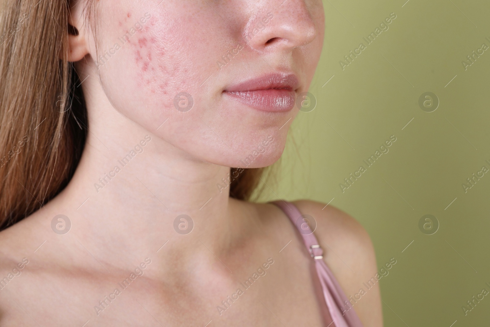 Photo of Young woman with acne problem on olive background, closeup