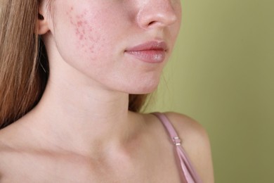 Young woman with acne problem on olive background, closeup