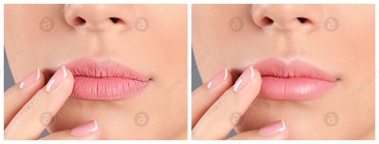 Image of Collage with photos of woman before and after using lip balm on grey background, closeup