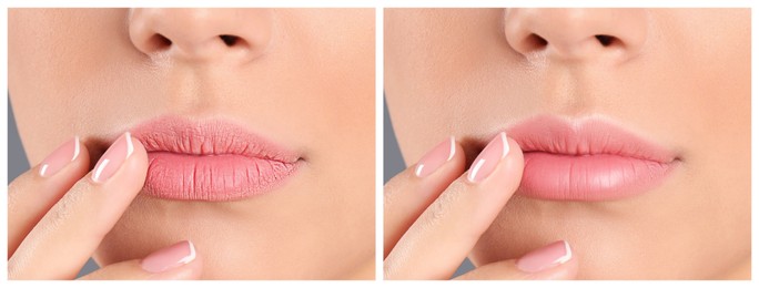 Image of Collage with photos of woman before and after using lip balm on grey background, closeup