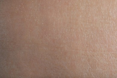 Photo of Closeup view of human skin as background